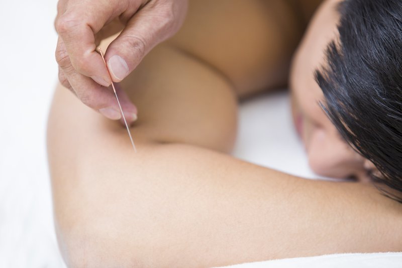 Patient receiving acupuncture