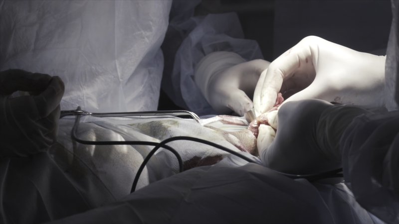 Close up detail of a surgery on male genitals with the professional equipment. Surgeons in sterile suits performing medical procedure, process of prostatectomy (prostate surgery).