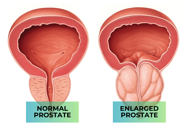 What Is Benign Prostate Hyperplasia (BPH) and How Common Is It?